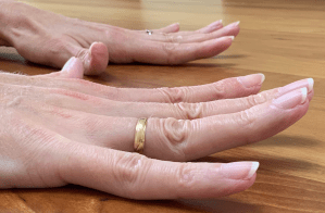 Close-up of a hand wearing a silver splint ring on the thumb, used as a brace to support hypermobile finger joints.